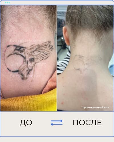 Удаление татуировки